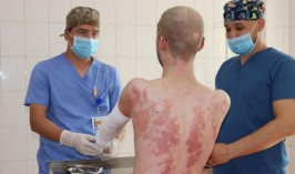 Абсолютный рекорд установили алматинские врачи: спасли пациента с 94% ожогом тела