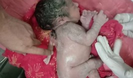 В Индии родился ребенок с третьей рукой на спине