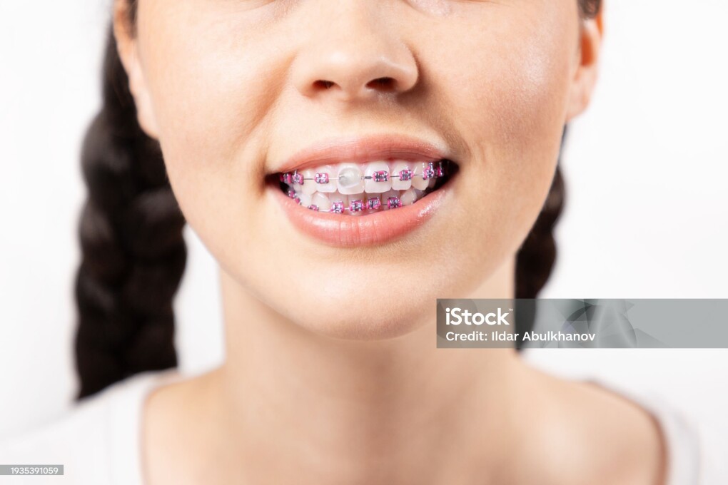 Close up of young Caucasian woman with brackets on teeth and orthodontic wax covering one ligature brace. White background. Concept of dental care during orthodontic treatment.