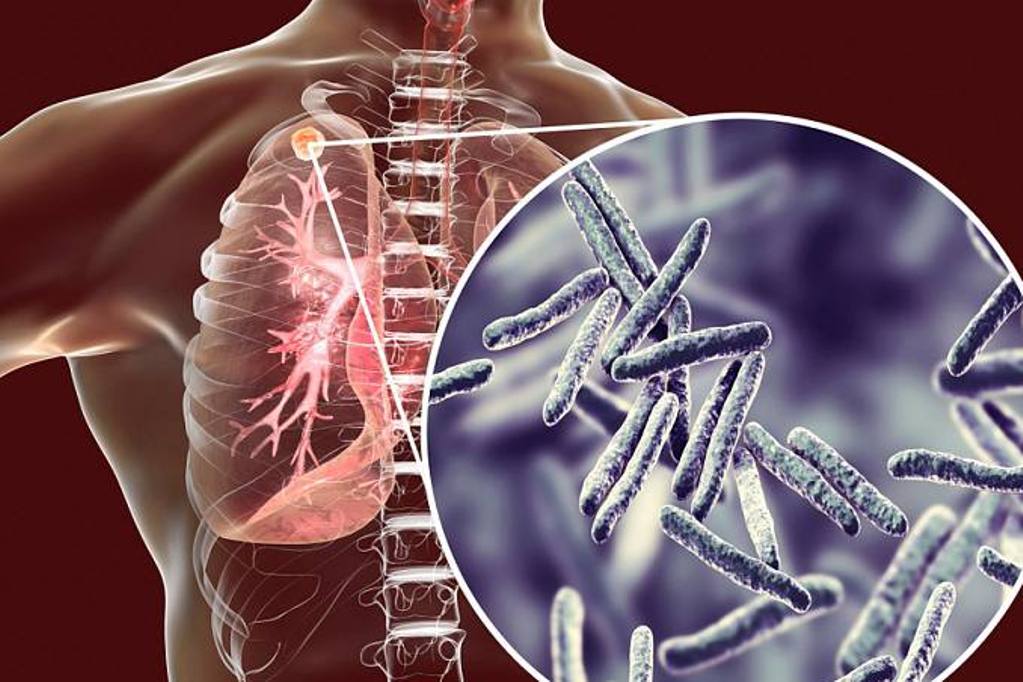 ae40768c-fc9a-4ac9-9ec2-094fef88f6cd туб