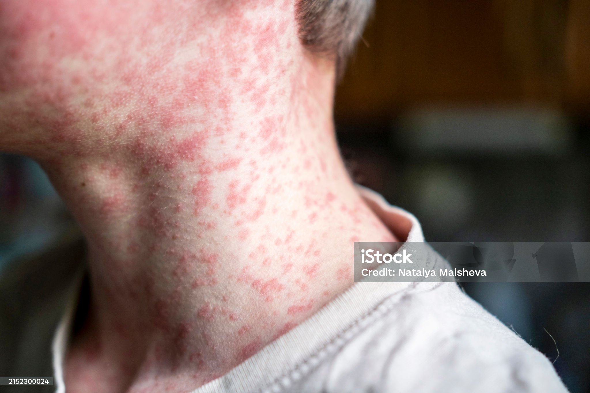 Measles viral disease, human skin covered with measles rash, vaccination concept