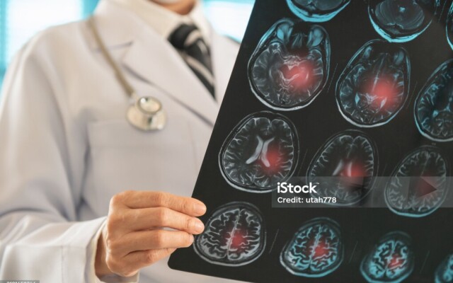 В Казахстане смертность от инсультов снизилась на 4%