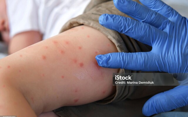 Батыс Қазақстан облысында 25 адамның қызылшамен ауырғаны расталды