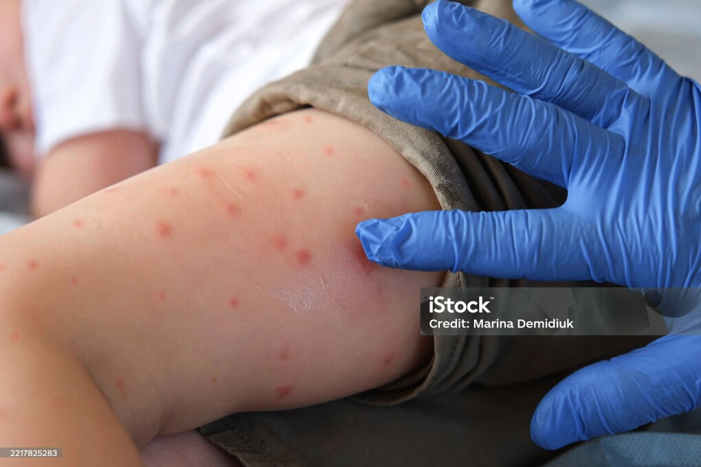 Doctor examining child with bodily red rash. Kid allergy closeup. Little baby scratches an eruption. Nurse applies special cream to atopic skin. Dermatitis, irritation, hive. Pruritus. Mosquito bites. Doctor Checking Skin of Sick Girl. Kid with Red Rash being Examined at the Physician. Allergic Rash, Chicken pox, Monkeypox Symptoms on the Body of Child. Health Problem. Bacterial Infections, Disease. Small Child with Red Rash. Baby with Red Spots Blisters on the skin. Close up of Painful Rash. Health Problem. Rubella, Chickenpox, Scarlet fever, Measles. Bacterial Infections, Disease.