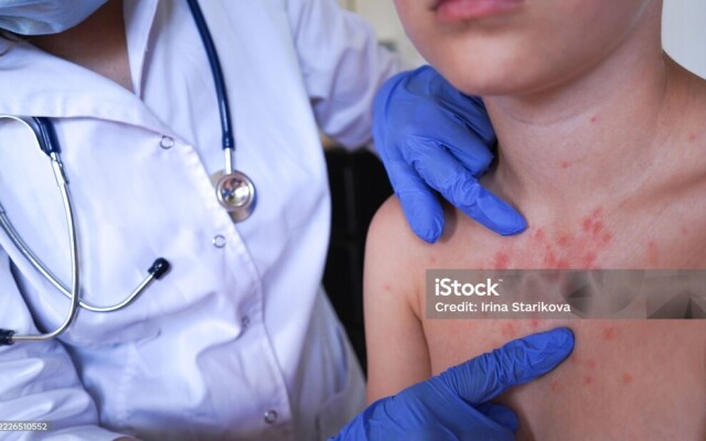 В ЗКО с начала года зарегистрировано 108 случаев кори