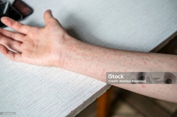 A teenager's hands covered in a measles rash.