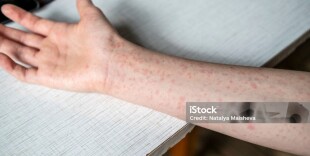 Батыс Қазақстанда жыл басынан бері 256 адам қызылша жұқтырды