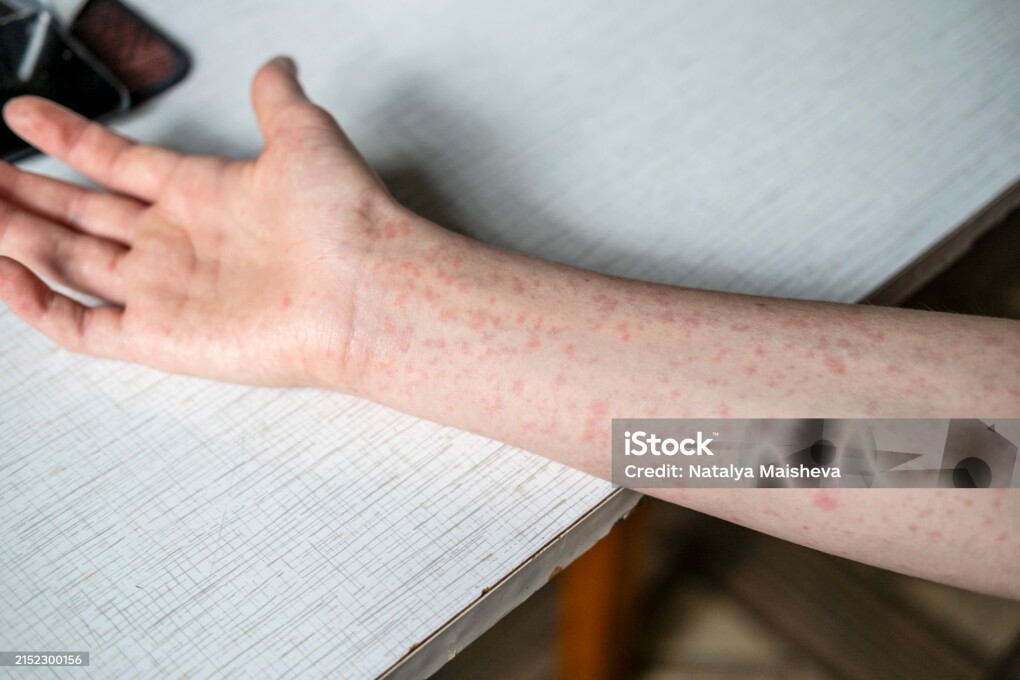 A teenager's hands covered in a measles rash.