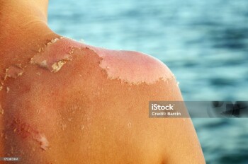 Peeling sunburned back
