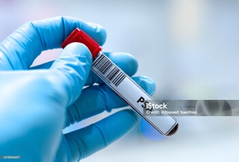 Blood sample tube for prostate specific antigen test analysis.