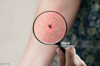 Tick bite on skin examined through a magnifying glass, representing Lyme disease risk, parasites, medical inspection, health awareness, and outdoor safety.