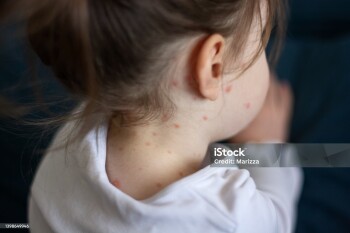 Close-up of a girl with chickenpox measles on the body