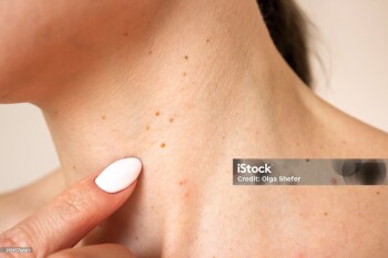 a photo of the neck of a young Caucasian woman suffering from a multitude of brown growths on the skin, papillomas. Skin diseases. Human papillomavirus. Laser removal of papillomas